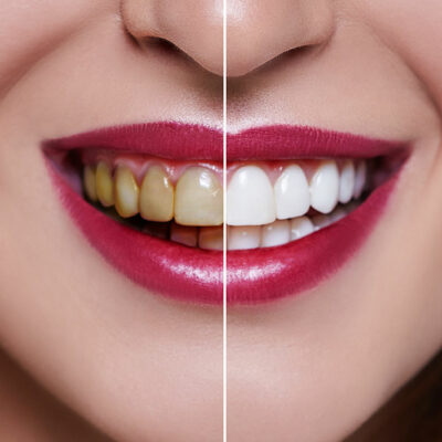 Dental veneers&#8217; cost, procedure, and results