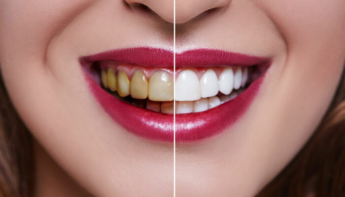 Dental veneers&#8217; cost, procedure, and results